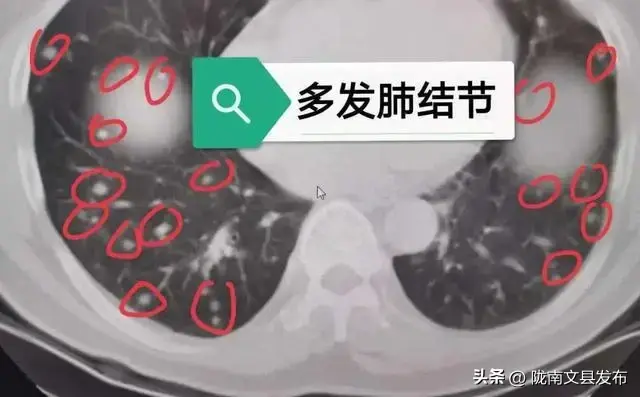 大虾，是肺结节的“催化剂”吗？医生：除了海鲜，这2物需少吃