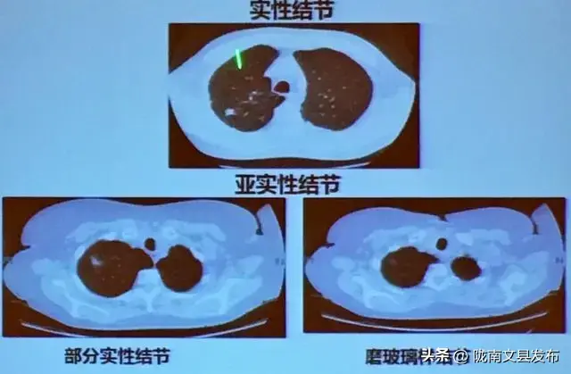 大虾，是肺结节的“催化剂”吗？医生：除了海鲜，这2物需少吃  第5张